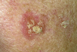 picture_of_actinic_keratosis