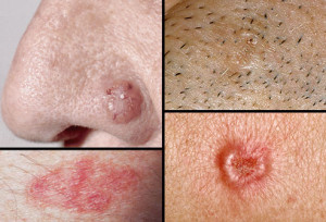 picture_of_basal_cell_carcinoma