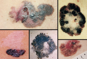 Pictures of melanoma