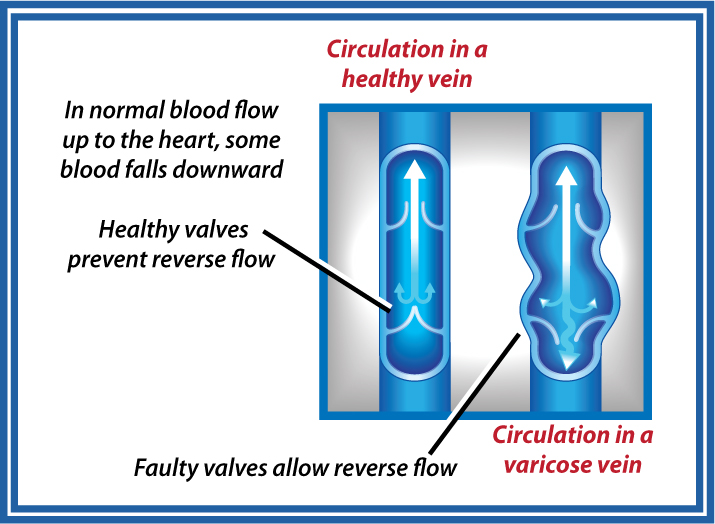 what's wrong with varicose vein