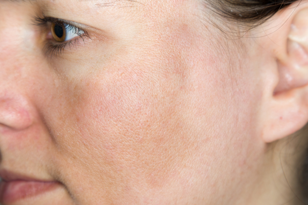 Sun-damaged skin: causes and effect