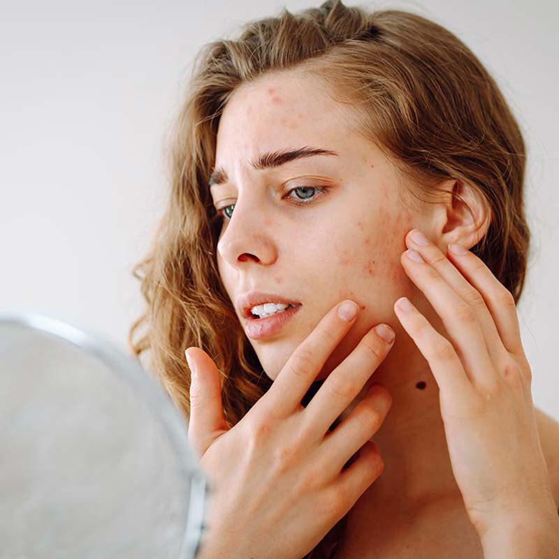 acne treatments by a dermatologist in lakewood ranch florida